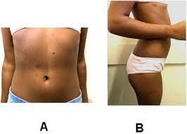 Neurofibromatosis is not a single medical disorder but refers to three different conditions involving the development of tumors that may affect the brain, spinal cord, and the nerves that send signals between the brain and spinal cord and all other parts of the body. Neurofibromatosis Type 1 State Of The Art Review With Emphasis On Pulmonary Involvement Respiratory Medicine