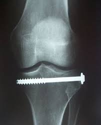 Tibial Plateau Fracture Surgery X Rays Fixation