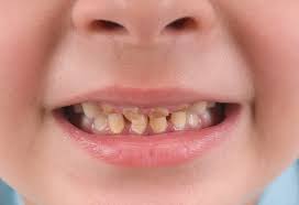 How to remove black tartar from teeth. Yellow And Other Tooth Discoloration In Children