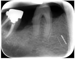 Murray schwartz an oral surgeon. The Strange Case Of A Broken Periodontal Instrument Tip Abstract Europe Pmc