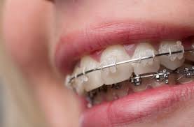 Die erste ursache des fehlbisses sind gekippte zähne. Zahnspange Ja Oder Nein Zu Viel Gitter Im Mund Wissen Stuttgarter Nachrichten