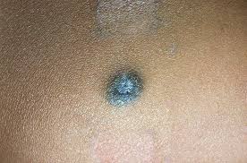 Image result for Blue Nevus
