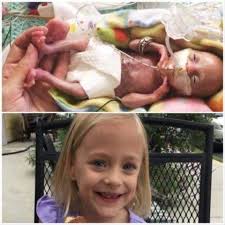 COMMUNITY SHARE Millie Irene was born at 32 weeks at 2lbs9oz. She had 56  days in the NICU with many different forms of oxygen support needed. She  then came home