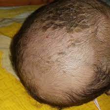 It's caused by overactive oil glands in the scalp. Mere Baby Ka Scalp Thik Hoga Kya Red Spot Is Sindur Ignore It Cradle Cap Remove Hone K Bad Eisa Ho Gaya Hai Hair Growth Hoga Na Plz Reply Me Firstcry