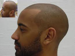 All banter and fighting seen in streams/videos are purely fictional and should not be taken seriously. Dark Scalp Micropigmentation Smp Darker Skin Skalptec Uk