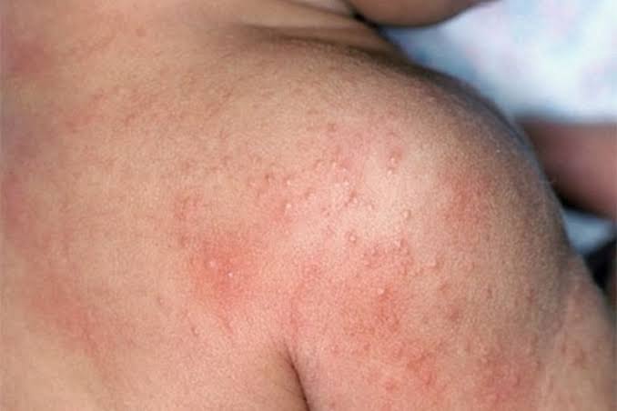 Nổi nốt đỏ trên da và ngứa - Biểu hiện lạ chớ nên xem thường