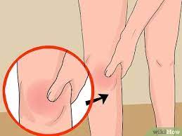 Jun 19, 2021 · persendian yang berisiko bengkak adalah ibu jari kaki, pergelangan kaki, lutut, pergelangan tangan, jari tangan, dan siku. 4 Cara Untuk Merawat Lutut Yang Bengkak Wikihow