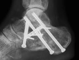Image result for Calcaneus Compression Fracture