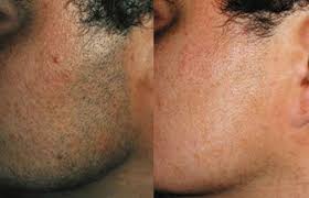 However, if your skin is feeling too sensitive, you may have a better experience waiting a week before your laser treatment. Laser Hair Removal San Diego Laser Hair Removal Before And After Photos For The Arm Pits Neck Face Legs Laser Hair Laser Hair Removal Hair Removal