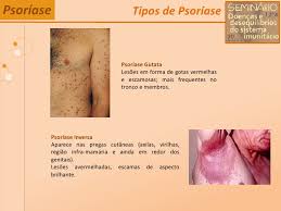 Como é feito o diagnóstico? Psoriase