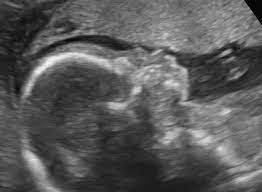 Ultrasound Features Of Fetal Syndromes Radiology Key