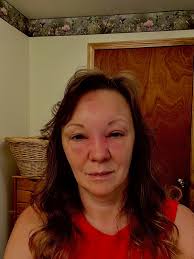 Organic remedies for bee sting swelling?