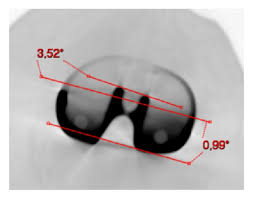 Left Knee Tibial Component Persona The Personalized Knee System Download Scientific Diagram 1) for free in pdf.