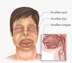 Image result for Angioedema