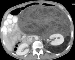 Myxoid Liposarcoma Ct Radiology Diagnostic Imaging Radiology Imaging