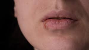 That causes cold sores around the mouth. New Herpes Vaccine Shows 93 67 Efficiency To Cure Hsv 1 Hsv 2 Business