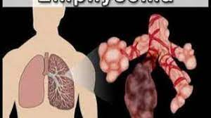 Chronic obstructive pulmonary disease (copd) is a disease that occurs with chronic bronchitis, emphysema, and/or asthma. Copd Chronic Obstructive Pulmonary Disease Physiopedia