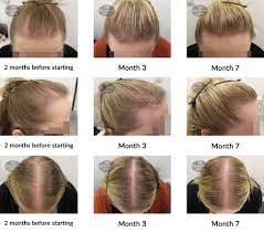 If you stand on your head you'll increase circulation, stimulating hair growth. Hair Growth Success Story Delighted With The Results So Far