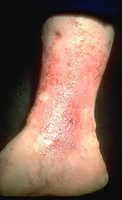 Image result for Stasis Dermatitis