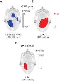 Arithmetic processing in children with dyscalculia: an event-related  potential study [PeerJ]