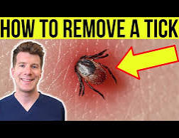 Doctor explains HOW TO REMOVE A TICK | Step-by-step guide ...