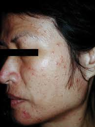 Image result for demodex rosacea