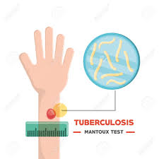 Tuberculosis skin test (tst) is a relatively safe testing method that can be used for most people, including infants and young children. Tuberculosis Design With Mantoux Test Related Icons Over White Royalty Free Cliparts Vectors And Stock Illustration Image 96712448