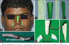 Figure 19 from Precision carving of costal cartilage graft for contour fill  in aesthetic and reconstructive rhinoplasty