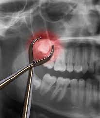 Maybe you would like to learn more about one of these? Tooth Extractions Dallas Tx Oral Surgeon Texas Wisdom Teeth