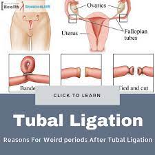 Possible Reasons For Weird Periods After Tubal Ligation