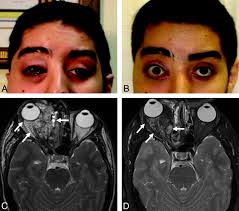 Percutaneous Sclerotherapy for Facial Venous Malformations: Subjective  Clinical and Objective MR Imaging Follow-Up Results