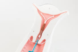 Love the copper iud as a birth control device. Iud Intrauterine Device Obstetrics Gynecology Of Atlanta