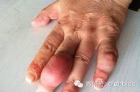 終於有救了 痛風的改善良方 請轉給身邊有痛風的人 raw diet treatment health
