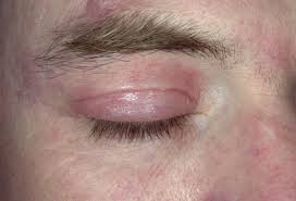 Eczema is a common condition, affecting about 30 million americans a year. Eczema Pictures What An Eczema Rash Looks Like