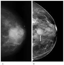 It can also be used to investigate the cause of breast problems, such as a breast mass, pain and nipple. Know Your Screening Options Brem Foundation