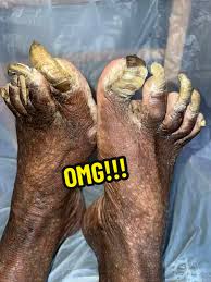 Image result for Onychogryphosis feet