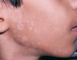 تعرف على البهاق اعراضه اسبابه و طرق العلاج طبيبك كوم