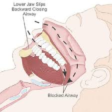 Medicare And Many Insurance Companies Provide For Regular Maintenance And Will Cover Up To 100 Of The Cost Of Cpap Machine Cpap Sleep Apnea Therapy Equipment
