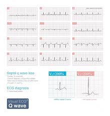 Image result for Q Wave
