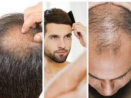 Namun, jika lebih banyak rambut gugur, ditambah dengan kehadiran kelemumur, hal ini boleh mengundang rasa tidak yakin diri dan rimas. Dah Mula Botak Sebab Rambut Gugur Ini Tip Mudah Yang Anda Boleh Ikut Maskulin