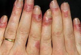 Systemic Lupus Erythematosus-Causes-Symptoms-Diagnosis-Treatment-Homeopathic Treatment-Best Homeopathic doctor-Dr Qaisar Ahmed-Al-Haytham clinic-Risalpur-KPK-Pakistan
