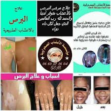 داء البرص تعرفوا عليه علاجه بين أيديكم مؤسسة الأعشاب الصحراوية Facebook