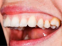 How To Whiten Your Teeth Naturally 6 Home Remedies