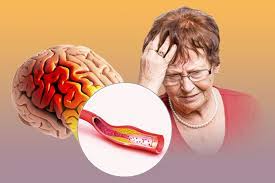 Este tipo de accidente cerebrovascular es causado. Isquemia Cerebral Aguda Una Amenaza Creciente Gaceta Unam