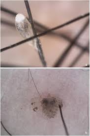 Image result for pubic lice symptoms