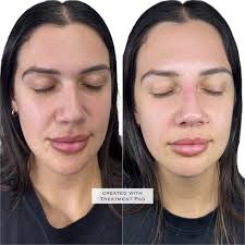 Just like magic 😍 Liquid rhinoplasty is definitely one of my favourite  treatments to perform! The results from a liquid rhinoplasty can be so  satisfying and so quick, often eliminating the need