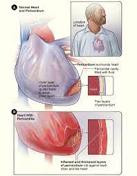 The pericardium is a thin tissue sac that surrounds the heart and consists of: Department Of Surgery Pericarditis