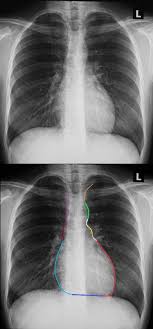 Evaluation of a chest radiograph may appear to be simple, but is in fact a complex task requiring careful observation, sound understanding of chest anatomy, and knowledge of the principles of physiology and pathology. Chest X Ray Heart Parts Frontal View Heart
