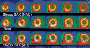 Breast lumps are a very common complaint for women of all ages. Shifting Breast Attenuation In 60 Year Old Women Came With Chest Pain Download Scientific Diagram
