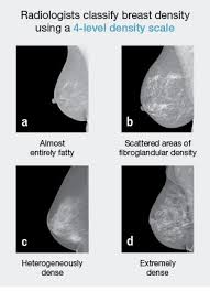 Find out more about breast cancer causes. Study Shows Breast Density Is Most Common Risk Factor For Breast Cancer